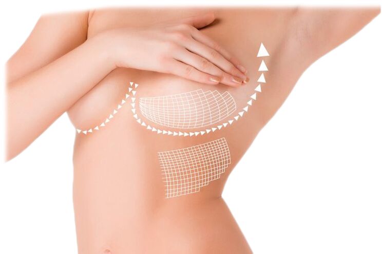 Action of Mammax capsules for breast augmentation