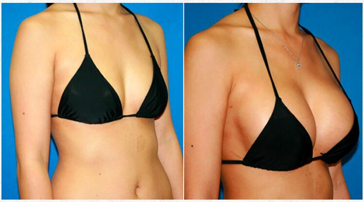 Before and after breast augmentation with plastic surgery