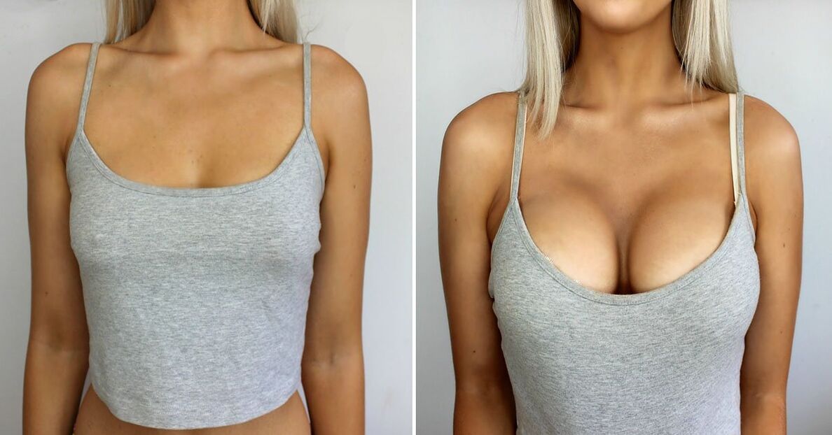Before and after increased breast
