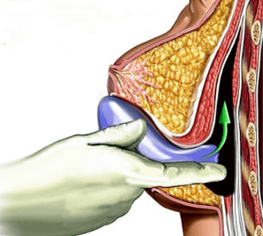 breast enlargement implant