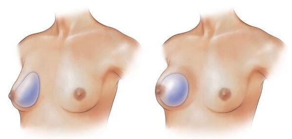 round and drop-shaped implants for breast augmentation